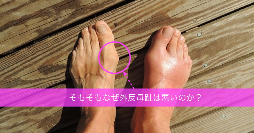 なぜ外反母趾は悪いのか？