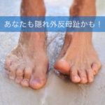 あなたも「隠れ外反母趾」かも！？