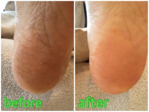 角質ケアの施術例01