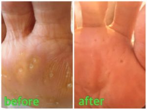 粟状魚の目施術例01