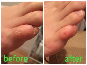 小指のタコ施術例01