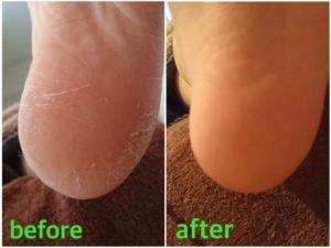 角質ケア施術例02