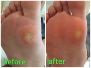 タコの施術例02