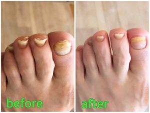 肥厚爪のケア01